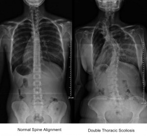 Combined normal and Thoracic